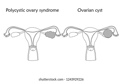 Polycystic Ovary Syndrome Ovarian Cyst Human Stock Vector (Royalty Free ...