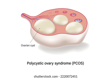 Vector de sección transversal del síndrome ovario poliquístico PCOS. Ciclistas ováricos. Enfermedad ovárica femenina.