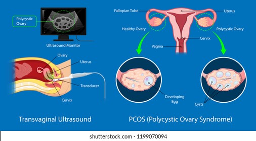 Polycystic Ovary Syndrome Pcos Hormonal Diagnose Stock Vector (Royalty ...