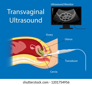 Suchen Sie Nach Polycystic Ovary Syndrome Pcos Hormonal Diagnose Stockbildern In Hd Und Millionen Weiteren Lizenzfreien Stockfotos Illustrationen Und Vektorgrafiken In Der Shutterstock Kollektion Jeden Tag Werden Tausende Neue Hochwertige