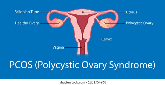 polycystic ovary syndrome PCOS hormonal diagnose diagnostic exam abnormal cancer fertility cysts physical organs blood transducer probe abdominal bleeding pain ectopic pregnancy uterine ovarian