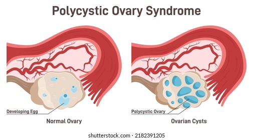 Polycystic Ovary Syndrome. PCOS Hormonal Disease. Female Reproductive System. Uterus, Cervix, Ovary And Fallopian Tubes. Cross Section Diagram, Reproductive System Studying. Flat Vector Illustration