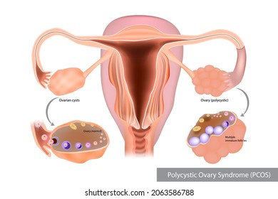 Polycystic Ovary Syndrome or PCOS. Multiple immature follicles or Ovarian cysts