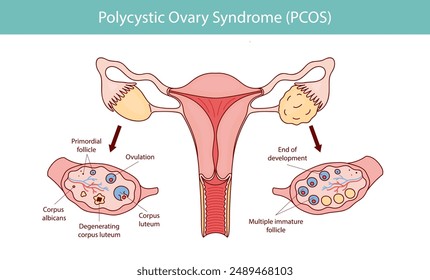 Síndrome de ovario poliquístico PCOS. Quistes ováricos del sistema reproductor femenino. La ilustración del Año Nuevo está dibujada a mano.