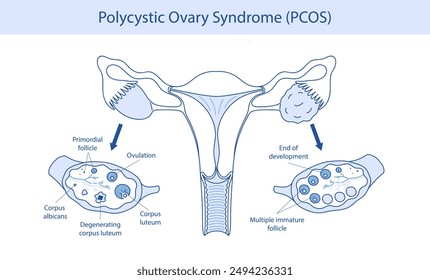 Polycystic ovary syndrome PCOS. Ovarian cysts of the female reproductive system. New Year illustration is hand drawn.