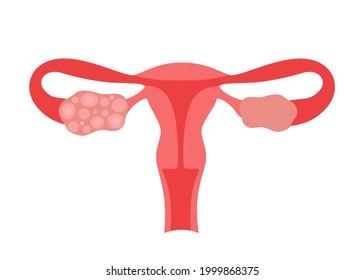 Polycystic Ovary Syndrome PCOS Of Woman. Female Reproductive System Disease. Abnormal Uterus Internal Organ. Vector Illustration