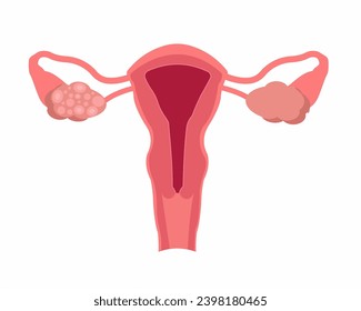 Polycystic ovary syndrome PCOS of women female reproductive system disease vector illustration.