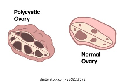 Polycystic Ovary Syndrome themed background