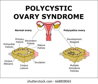 Polycystic Ovary Syndrome,color vector illustration