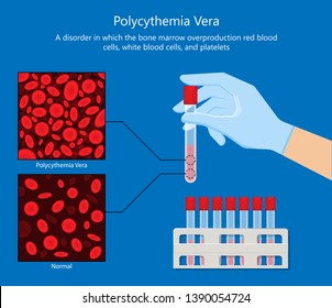 Polycythemia Vera PV Blood Clots Cancer Bone Marrow Diagnostic Complete Count Venous Thromboses