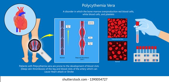 Polycythemia Vera PV Blood Clots Cancer Bone Marrow Diagnostic Complete Count Venous Thromboses