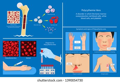 Polycythemia Vera PV Blood Clots Cancer Bone Marrow Diagnostic Complete Count Venous Thromboses