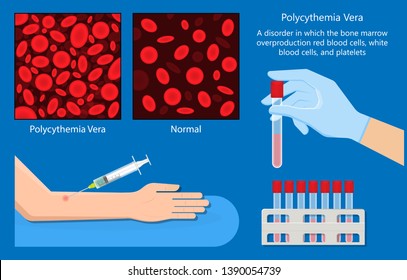 Polycythemia Vera PV Blood Clots Cancer Bone Marrow Diagnostic Complete Count Venous Thromboses