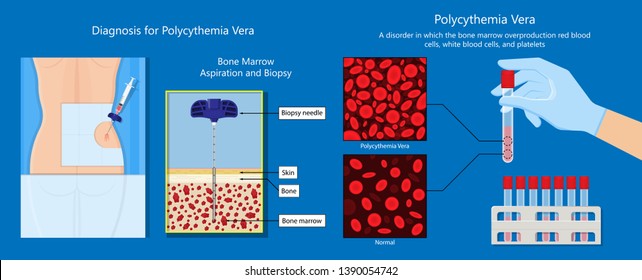 Polycythemia Vera PV Blood Clots Cancer Bone Marrow Diagnostic Complete Count Venous Thromboses