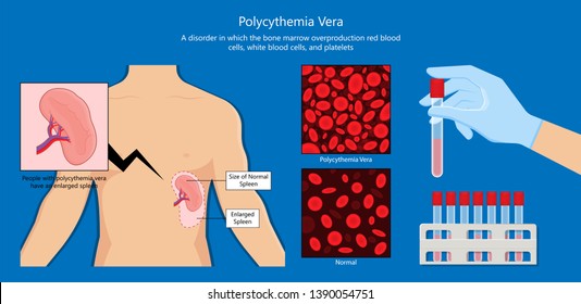 Polycythemia Vera PV Blood Clots Cancer Bone Marrow Diagnostic Complete Count Venous Thromboses