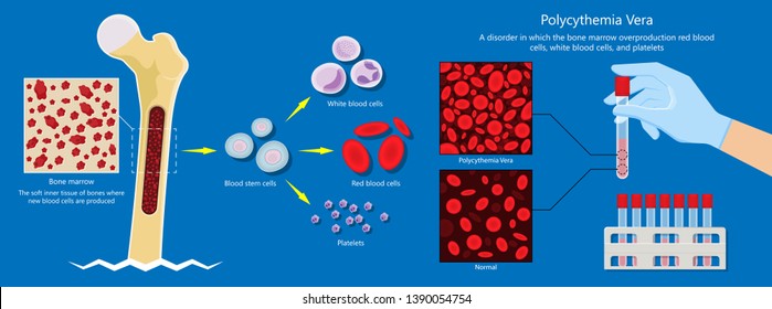 Polycythemia vera PV blood clots cancer bone marrow diagnostic complete count venous thromboses