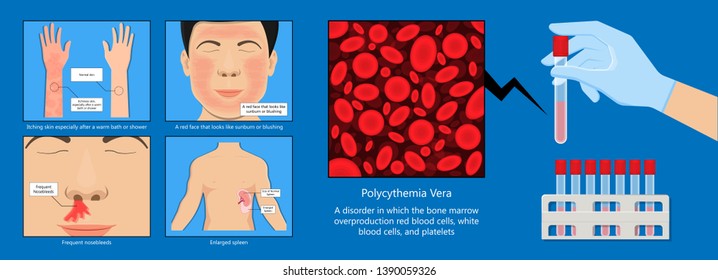 Polycythemia Vera PV Blood Clots Cancer Bone Marrow Diagnostic Complete Count Venous Thromboses