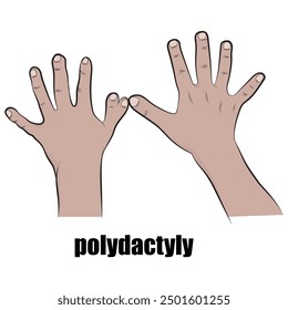 Polydactyly, a condition in which a person has more than the normal number of fingers or toes.