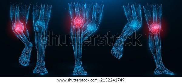 Polygonal vector illustration of human legs,\
inflammatory disease of the knee joint concept. Low poly art lower\
limbs on a dark blue\
background.