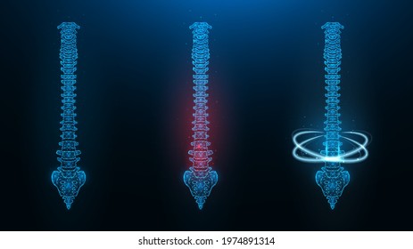 Polygonal vector illustration of a human spine. Image of a healthy, sick and recovering spine.