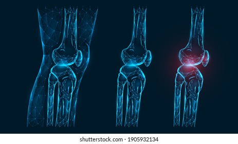 Polygonal vector illustration thigh and knee joint side view. Disease, pain, and inflammation of the knee joint. Low poly model of a healthy and injured human knee on a dark blue background