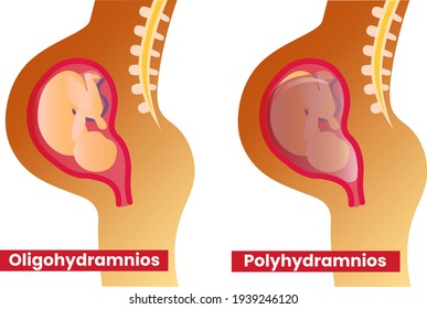 Polyhydramnios and oligohydramnios during pregnancy. Amniotic fluid abnormalities. Vector medical illustration.