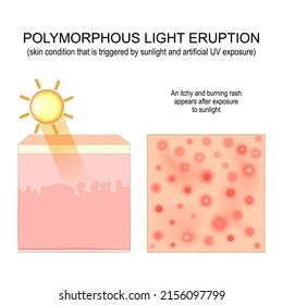Polymorphic light eruption. An itchy and burning rash appears after exposure to sunlight. Close-up of skin rash. cross section of the skin. vector illustration