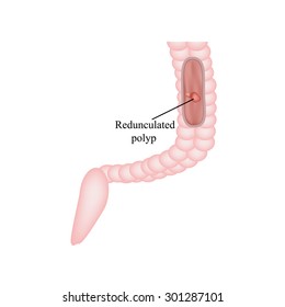 Polyp in the intestine. Polyp in the colon. Vector illustration on isolated background.