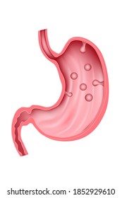 polyp of the stomach. Pathology of the digestive system. Vector illustration.