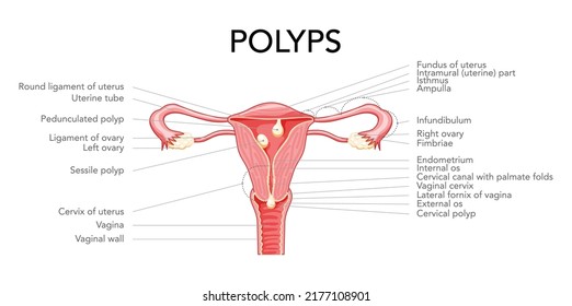 Polyp In The Uterus With Inscriptions Diagram Female Reproductive System In Cross Sections. Front View In A Cut. Human Anatomy Diseases Internal Organs Location Scheme, Cervix, Ovary Flat Style Icon