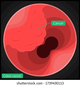 Polypectomy Procedure To Remove Polyps From The Colon Medical