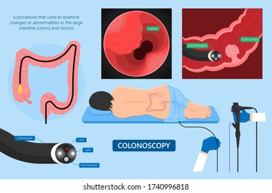 Polypectomy Procedure To Remove Polyps From The Colon Medical