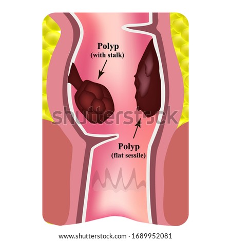 Polyps in the rectum. The structure of the rectum of the intestine. Types of polyps in the colon. Infographics. Vector illustration on isolated background.