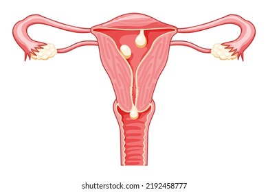 Polyps in the uterus - cervical, pedunculated and sessile Female reproductive system in cross sections. Front view in a cut. Human anatomy diseases internal organs location scheme flat style icon