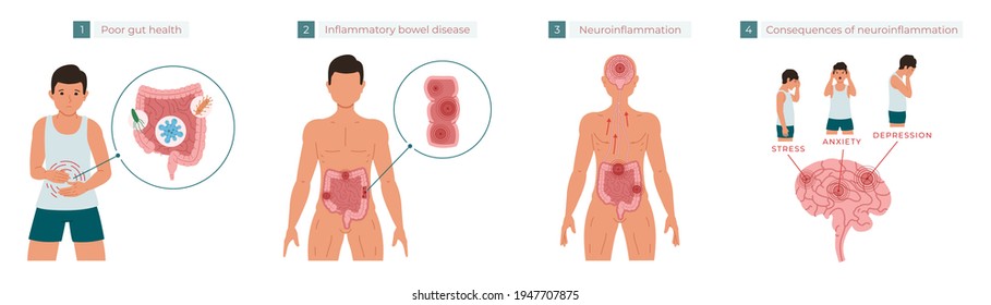 Poor gut health leads to chronic inflammation, which in turn leads to neuroinflammation, which can cause stress, anxiety, and depression. Vector illustration
