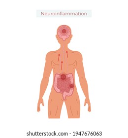 Poor gut health leads to neuroinflammation vector illustration.