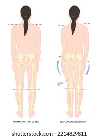 poor postural stand with toe walking ankle syndrome Unequal short leg length discrepancy tilt curvature body misaligned High pelvis femur Limb bone tilting shoulder