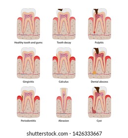 Popular teeth diseases icons in flat design, vector medical illustration. Dental common problems infographic elements isolated on white background. Healthy and unhealthy teeth set of anatomical icons.