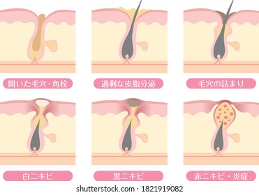 Pore condition and acne mechanism

In Japanese, it is described as "open pores", "excessive sebum secretion", "clogging of pores", "white acne", "black acne", and "red acne / inflammation".