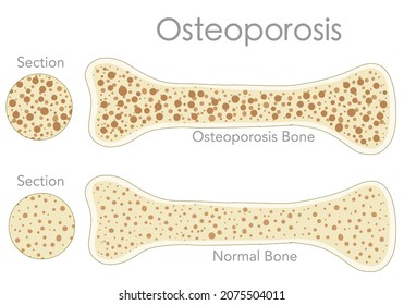 Hueso poroso, Osteoporosis. Sección transversal ósea, estructura. Pareja, normal, salud, masa y poro, frágil, esponjosa, hueso osteoporótico, diagrama anatómico. Espalda blanca, texturas. Vector de ilustración médica