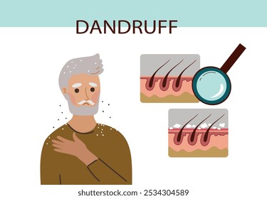 Retrato de homem idoso com problema de caspa. Infográfico. Medicina da saúde, tricologia, conceito dermatológico. Ilustração de desenho plano à mão desenhada em vetor.