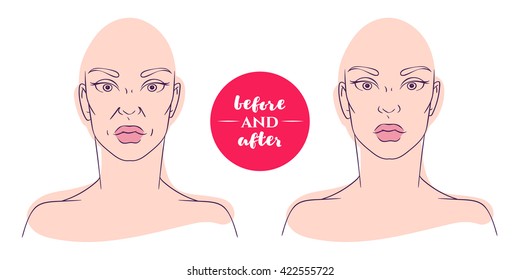 Portrait of a woman before and after with cosmetic defects. Plastic surgery and correction of deficiencies in appearance. Correction of nasolabial folds