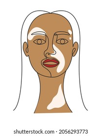 Portrait of a woman with vitiligo line art vector illustration. Adult beautiful girl with skin pigmentation. Hand drawing female silhouette.