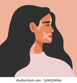 Portrait of an young woman with vitiligo in profile. Avatar of young girl with pigmentation on the skin. Vector illustration