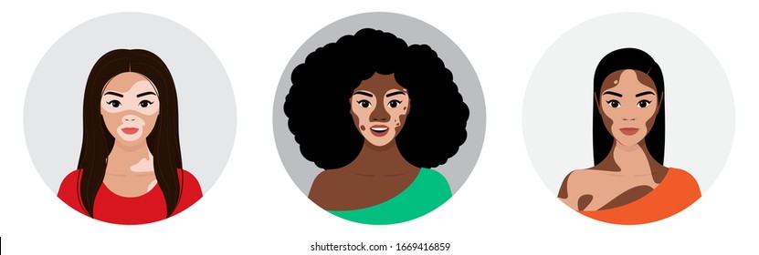 Portraits of three girls with vitiligo on their face and body. Avatars of European, African and African- American women in the circle. Vector stock flat illustration on transparent background