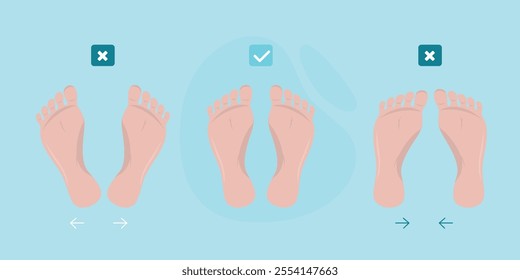 Position of the feet in varus and valgus deformities. Depicted is imprint of the feet. Injury, bow legs. Correct and incorrect footprints. Infographic, template, horizontal banner. vector illustration