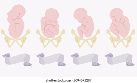 position of the fetus in late pregnancy. Breech presentation of the fetus in the womb.