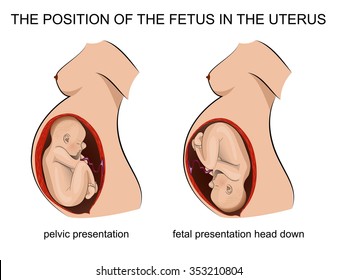 The Position Of The Fetus In The Uterus