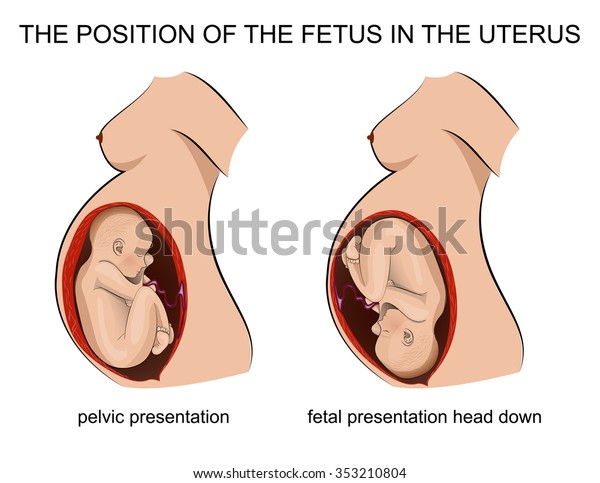 子宮内の胎児の位置 のベクター画像素材 ロイヤリティフリー