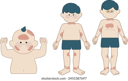 la posición de la piel que es altamente posible de contraer dermatitis atópica - ilustración plana 